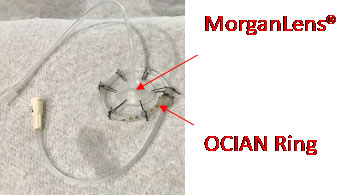 Ocular Chemical Injury Active Neutralization